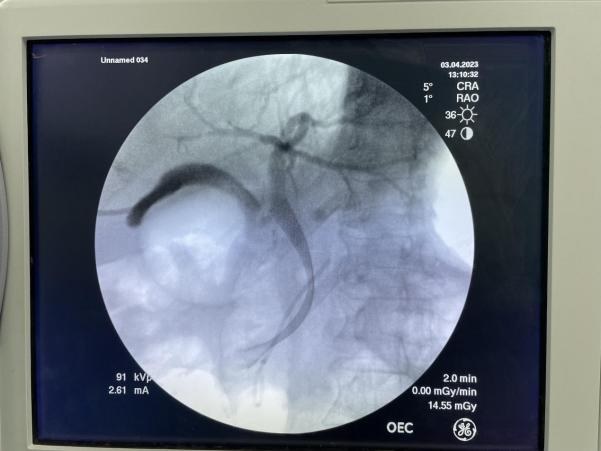 内镜下逆行胰胆管造影（ERCP）配图